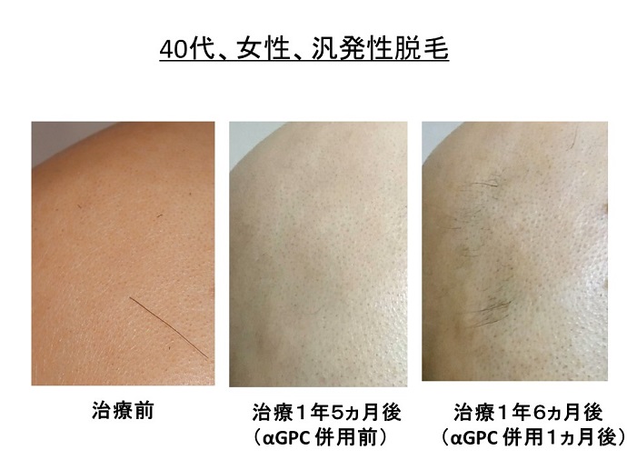 円形脱毛症　病院